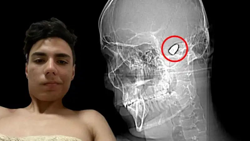 Hayatı Tehlikede: Kafasında Patlayıcı ile Yaşayan Adamın İnanılmaz Hikayesi